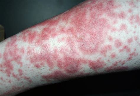 Diabetic skin rash pictures | Symptoms and pictures