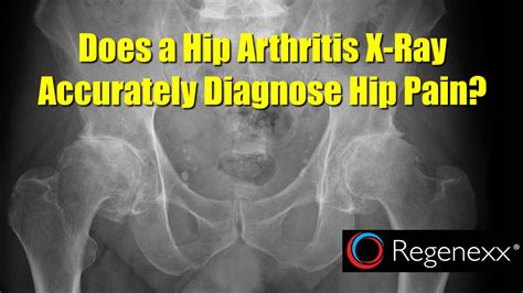 Hip Arthritis X-Ray Not Associated with Pain? - Regenexx®