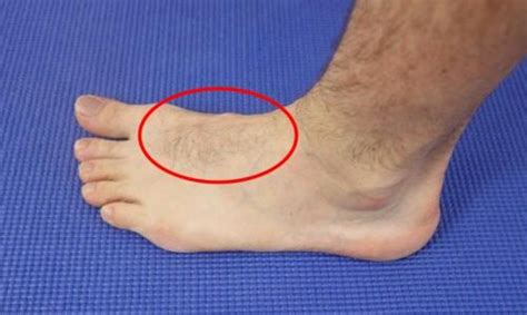 Do you have a Bump on Top of the Foot? [Hard, Painful or Bone Bump]