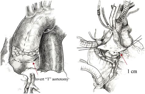 Trileaflet Aortic Valve Reconstruction Using Bovine Pericardium - Heart ...