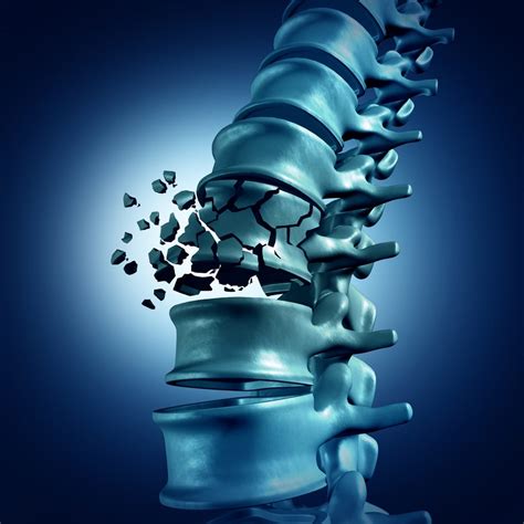 Burst Fractures and Treatment Options - Spine Center of Texas