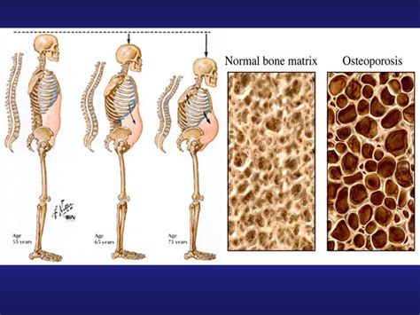 What is normal bone density range: Bone Density Test, Osteoporosis ...