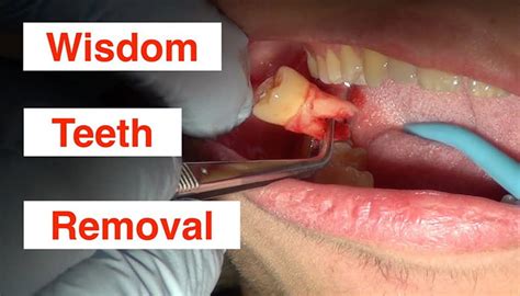 What you should know about wisdom tooth extraction pain