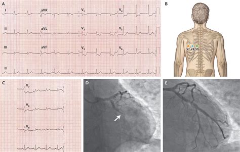 Posterior Myocardial Infarction Ecg