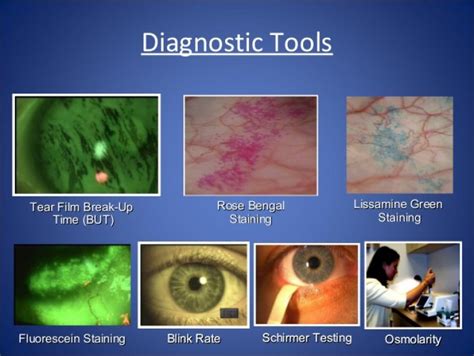 Innovations in Dry Eye Testing: New Diagnostic Tools | OBN