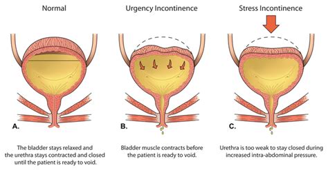 Stress Incontinence in Women | Sports & Spinal Physiotherapy HK