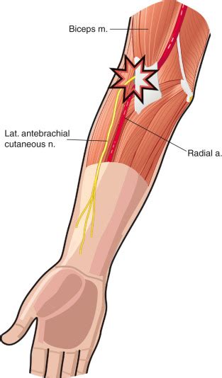 Lateral Antebrachial Cutaneous Nerve Entrapment at the Elbow ...