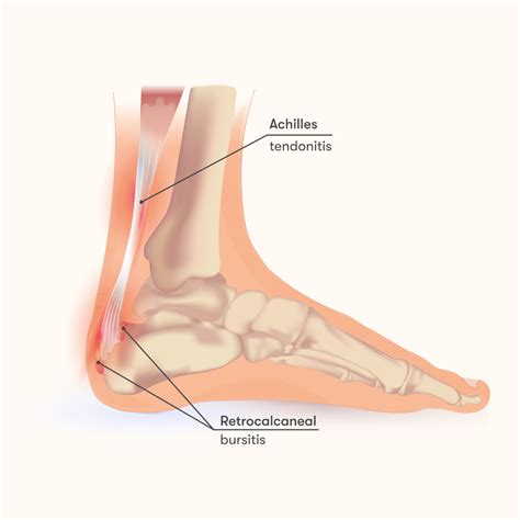 Retrocalcaneal Bursitis: Causes, Symptoms & Treatment