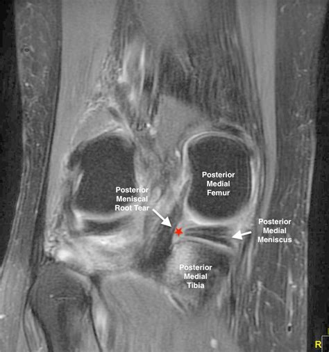 Root Tears Of The Meniscus (Video) - Jeffrey H. Berg, M.D.