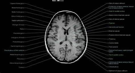 Anatomy Of Brain Mri - Anatomical Charts & Posters