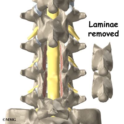 Lumbar Laminectomy - eOrthopod.com