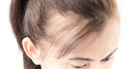 Lupus Hair Loss – Causes, Symptoms And Treatments