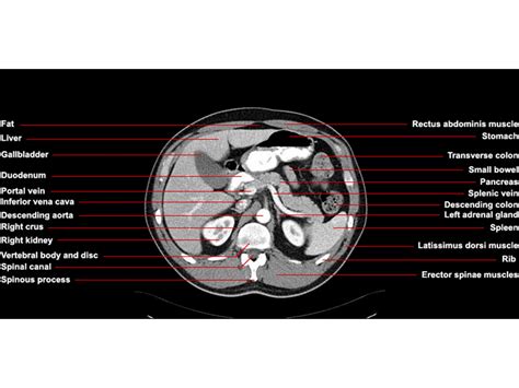 CT of the Abdomen Axial Anatomy – RADIOLOGYPICS.COM