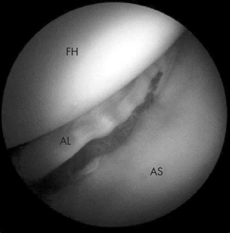 A peripheral tear of the acetabular labrum. AL, acetabular labrum; AS ...