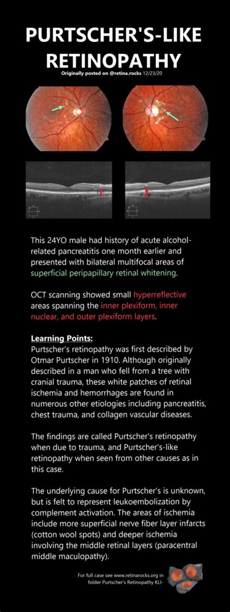 Trauma > Purtscher Retinopathy - Retina Rocks