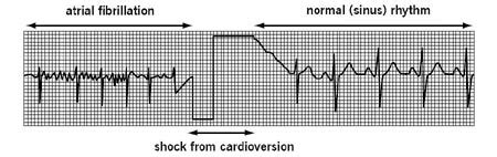 Electrical Cardioversion | Cleveland Clinic