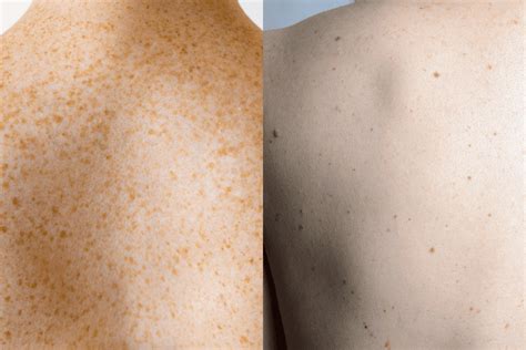 Freckles vs. Moles: Understanding the Difference