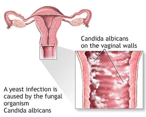 Yeast Infection Sores Vs Herpes