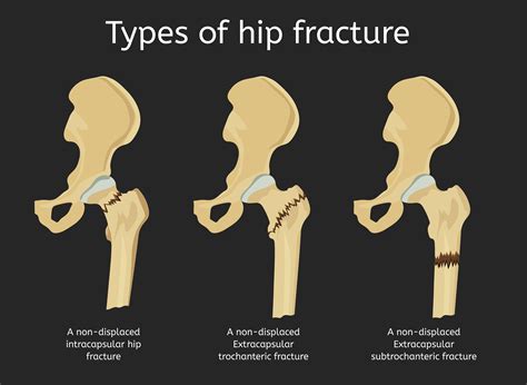 Effectiveness of weekend physical rehab for functional recovery in ...