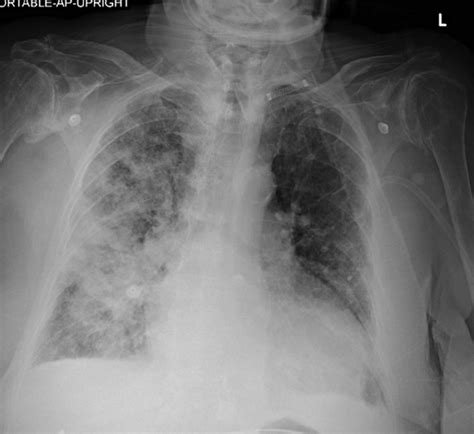 Cureus | Unilateral Diffuse Alveolar Hemorrhage Due to Selective ...