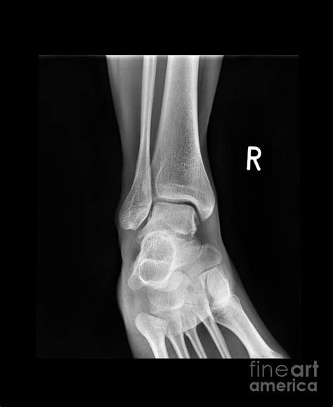 Ankle Bone Fracture, X-ray #1 by Science Photo Library