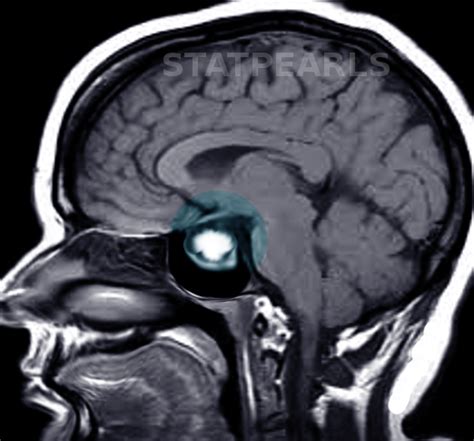 Prolactinoma Article