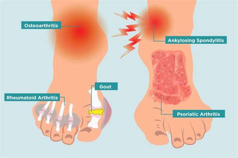 Arthritis in Your Feet: Causes, Symptoms, and Treatment