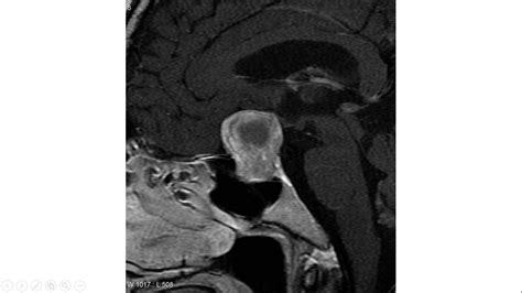 Prolactinoma MRI - wikidoc