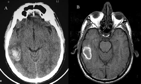 Brain Jack Image: Brain Ct Scan