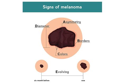 ABCDE of Skin Cancer | Cone Health