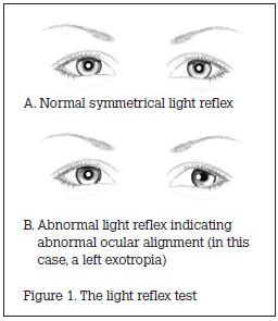 Screening for Strabismus | Squint Examination - Utsav Eye Clinic