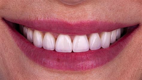 Porcelain Veneers Smile Gallery - Skoulas DDS - The SF Cosmetic Dentist