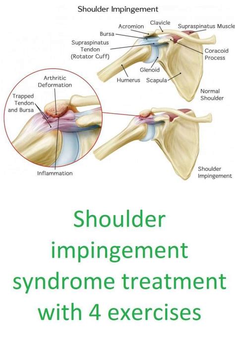 Shoulder Impingement Syndrome Treatment