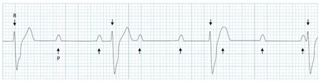 Top 16 third degree heart block ecg 2022