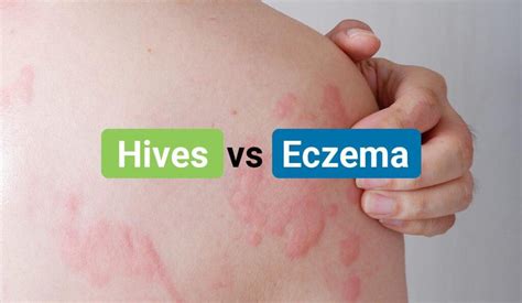 Hives vs Eczema – Differences, Similarities, Causes, Treatments