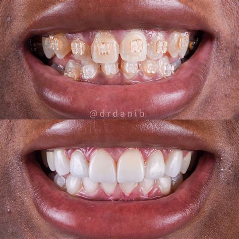 Teeth Veneers Before And After