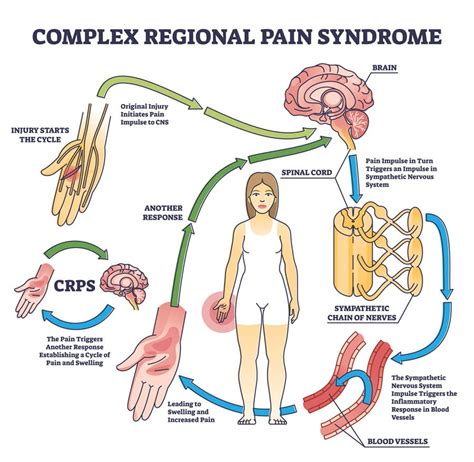 Complex Regional Pain Syndrome - Monarch Pain Management