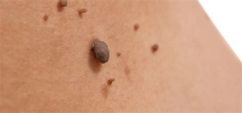 The Shocking Truth About Moles