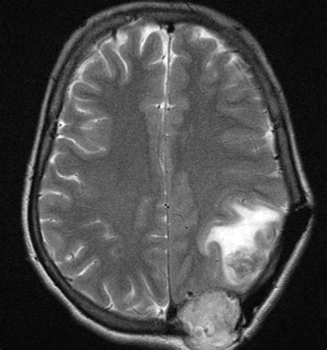 Follicular thyroid cancer MRI - wikidoc