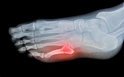 Metatarsal Fractures and Stress Fractures | Great Neck Family Foot Care