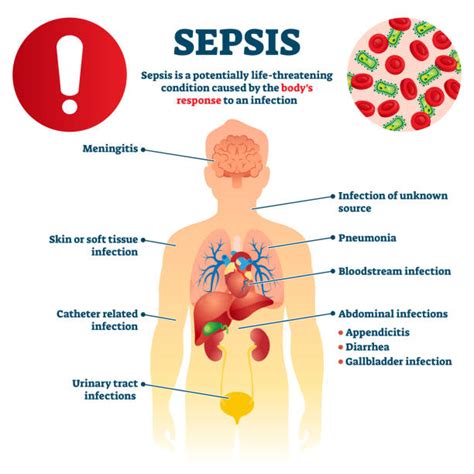 540+ Sepsis Stock Illustrations, Royalty-Free Vector Graphics & Clip ...