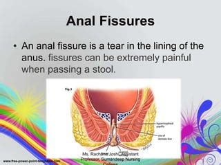 Sitz bath Procedure | PPT