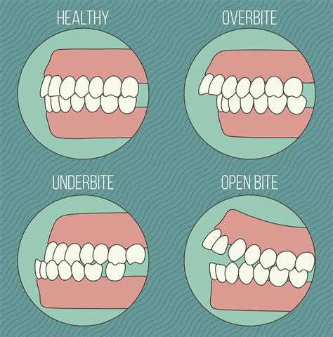 What Does Bite Mean In Orthodontics? - ArchWired