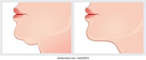 Double Chin Before After Vector Image Stock Vector (Royalty Free ...