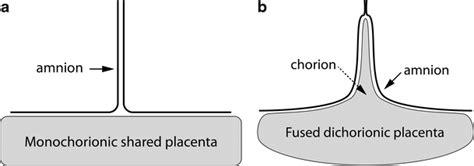 Diagrams illustrate the “T” and “lambda (λ)” signs in early pregnancy ...