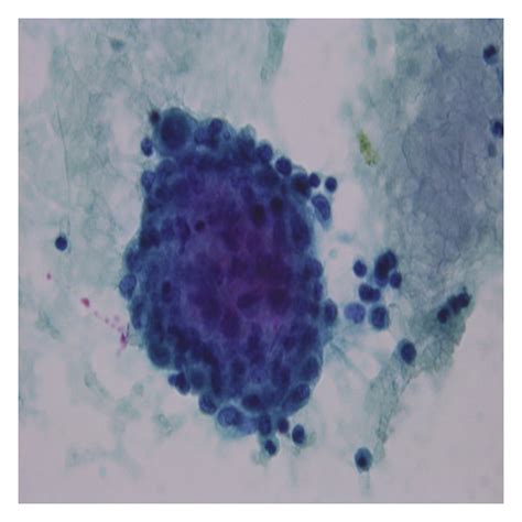 Pleural fluid cytology, PAP stain (×40): mesothelial cells with ...