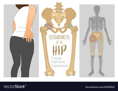 Hip osteoarthritis infographic Royalty Free Vector Image