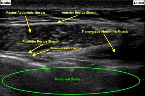 How I Do It: Ultrasound-Guided Rectus Sheath Blocks