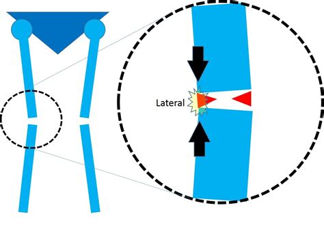 What is a Meniscal Cyst? Why You Should Care About the Hole in My ...