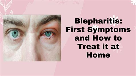 Understanding Blepharitis Causes and Treatment with Base Labs Hypochlo ...